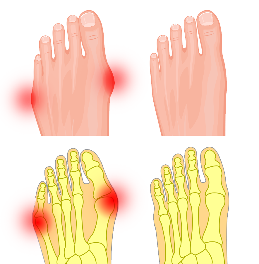 Minimally Invasive Bunion Surgery